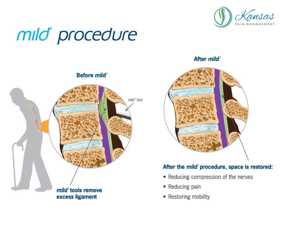 Avoid or Delay Back Surgery with Interventional Pain Management