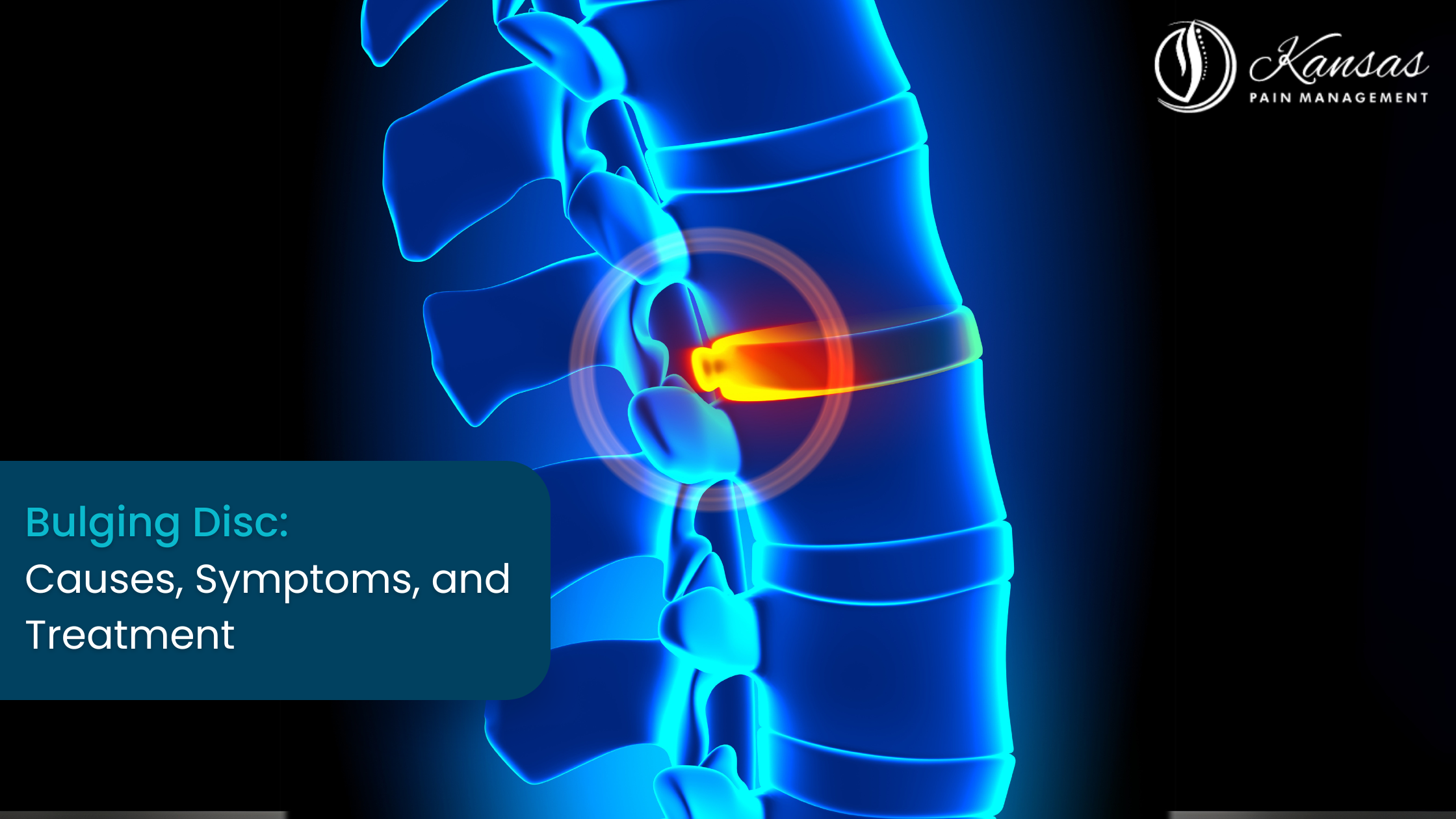 Bulging Disc: Causes, Symptoms, and Treatment