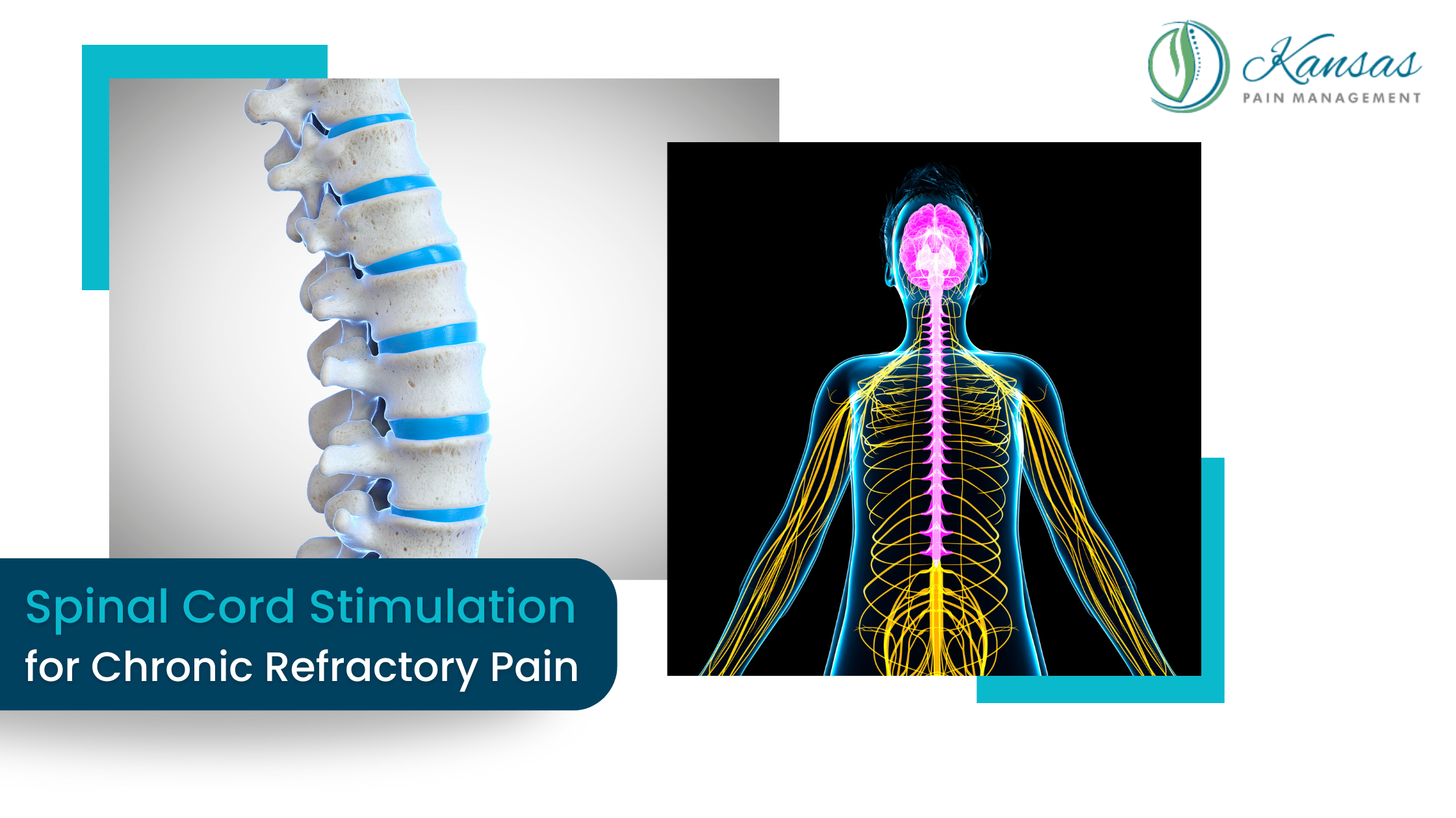 Health-Care Utilization and Outcomes with 10 kHz Spinal Cord Stimulation for Chronic Refractory Pain