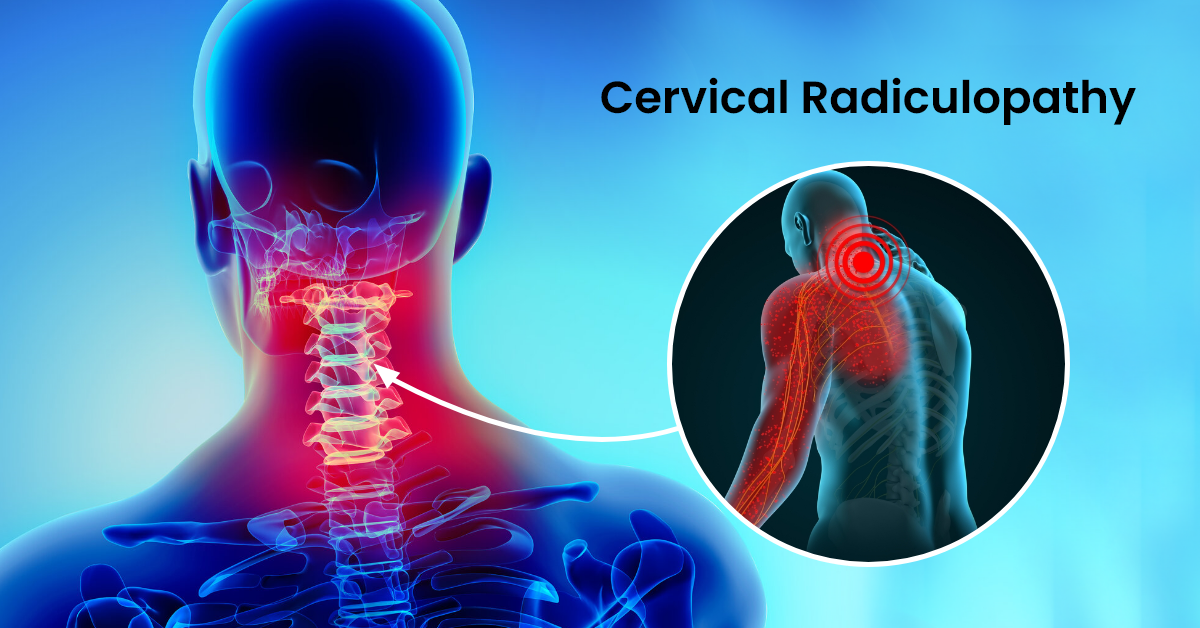 Cervical-Radiculopathy