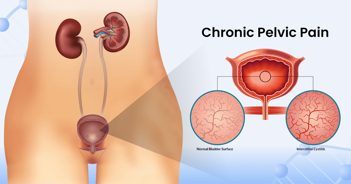 Chronic-Pelvic-Pain