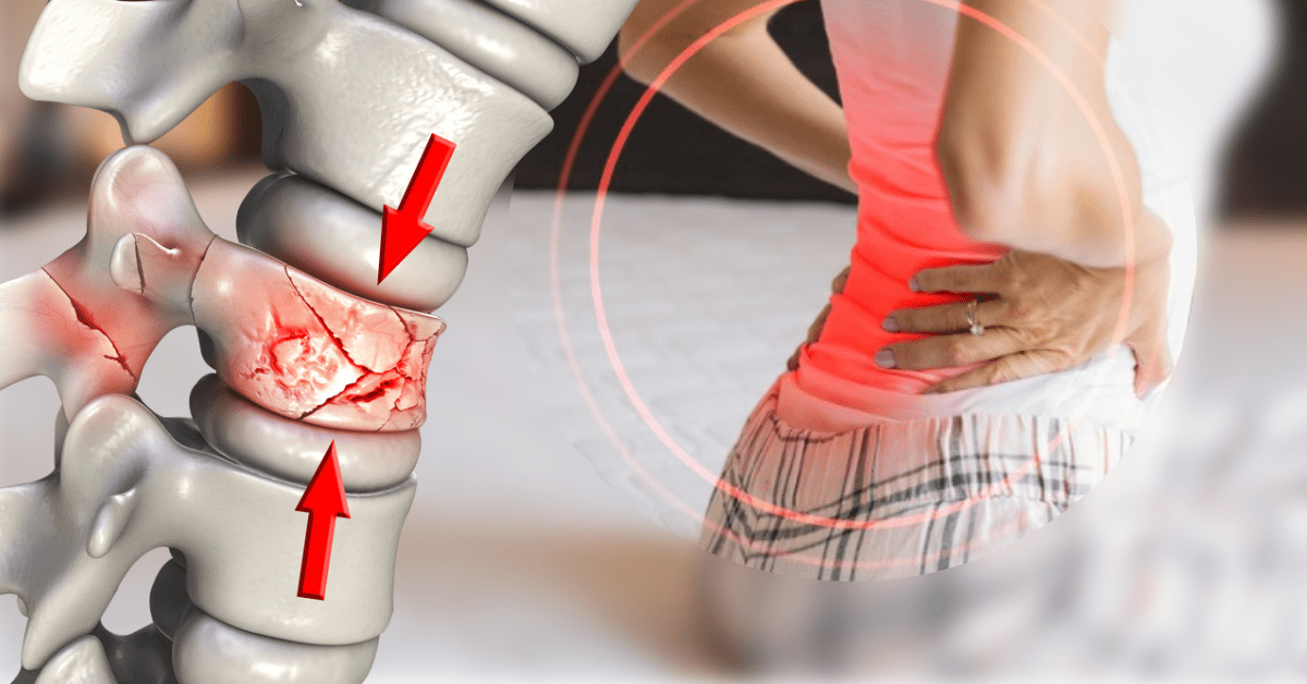 Compression-Fractures-Of-The-Spine