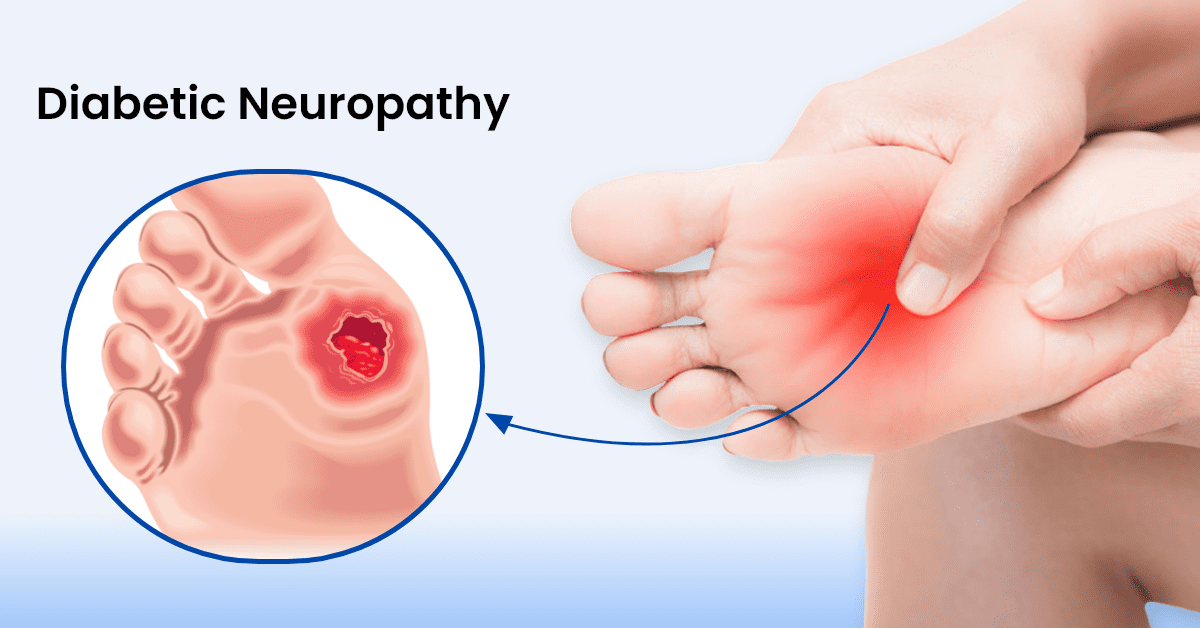 Diabetic-Neuropathy0