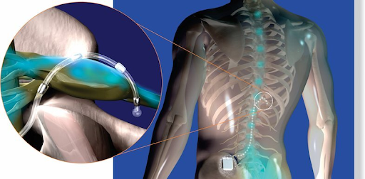 Dorsal-Root-Ganglion-DRG-Stimulator