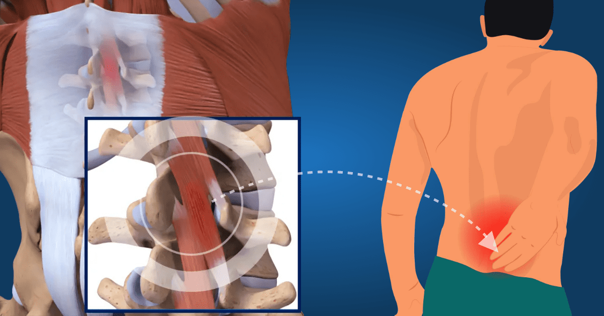 Low-Back-Pain0