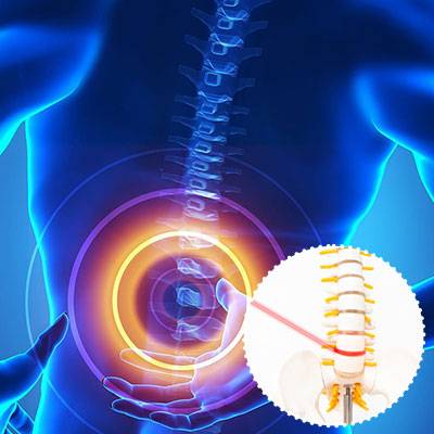 Lumbar-And-Lumbosacral-Radiculopathy