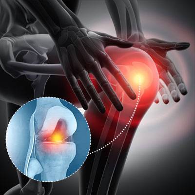 Osteoarthritis-Of-The-Knee