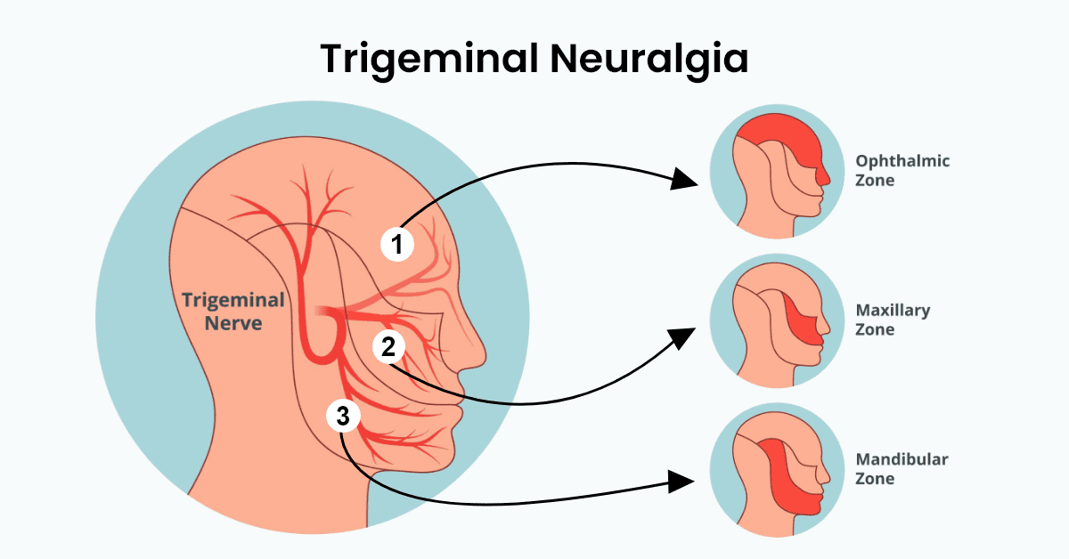 Trigeminal-Neuralgia0