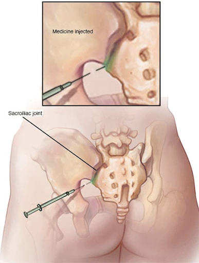 Sacroiliac Joint injection
