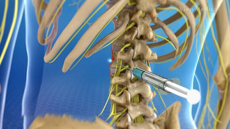 Sympathetic nerve block image