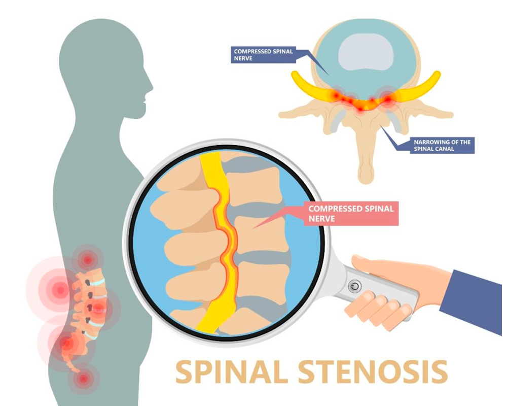spinal stenosis