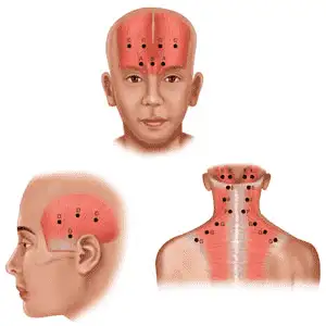 Botox-Injections