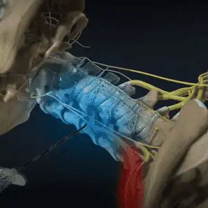 Cervical-Epidural-Steroid-Injection