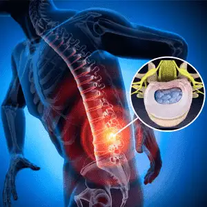Disc-Nucleoplasty