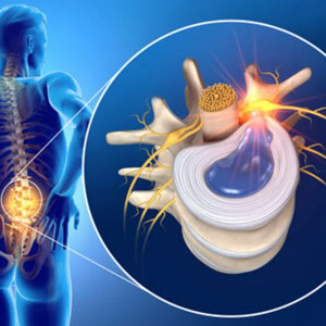 Endoscopic-Discectomy