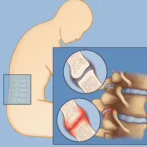 Facet-Joint-Syndrome