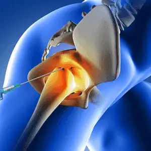 Hip-Joint-Injections