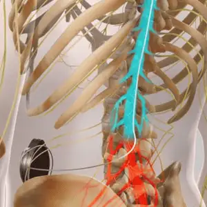 Intrathecal-Pain-Pumps