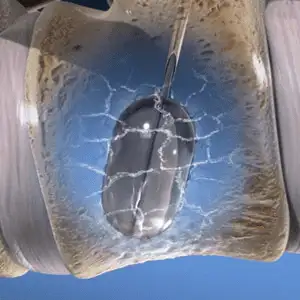 Kyphoplasty