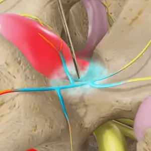 Medial-Branch-Block-MBB