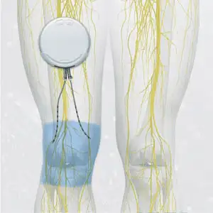 Peripheral-Nerve-Stimulator