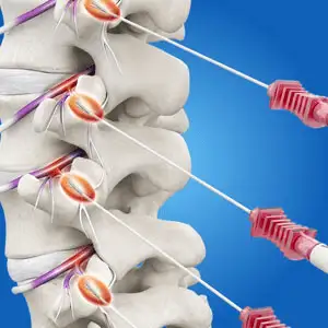 Radiofrequency-Ablation-RFA