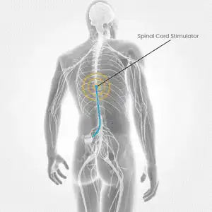 Spinal-Cord-Stimulation-SCS