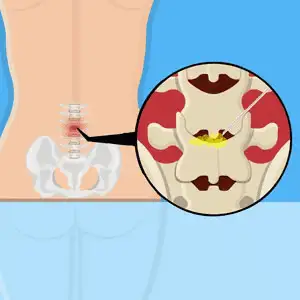 Transforaminal-Epidural-Spinal-Injection-TFESI