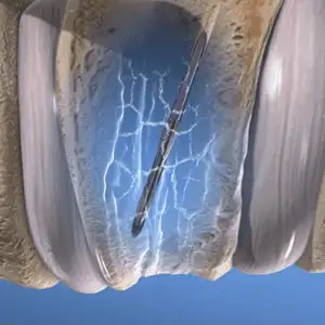 Vertebroplasty