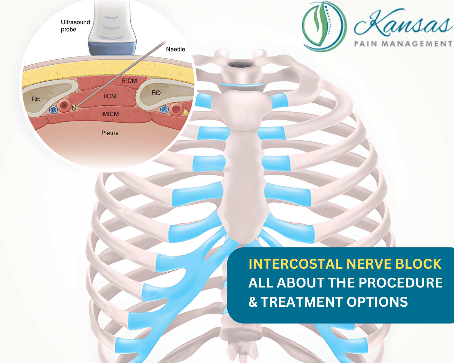 What Is An Intercostal Nerve Block? Treatment Options