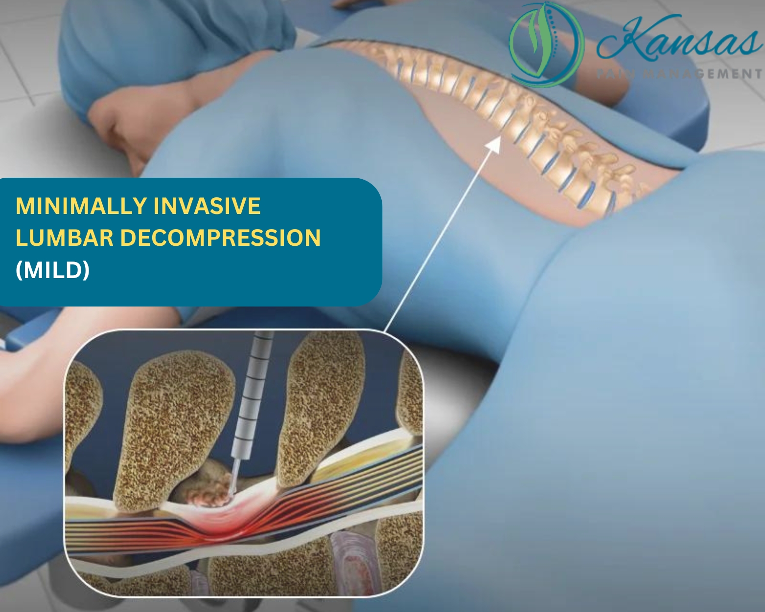 What is Minimally Invasive Lumbar Decompression (MILD)