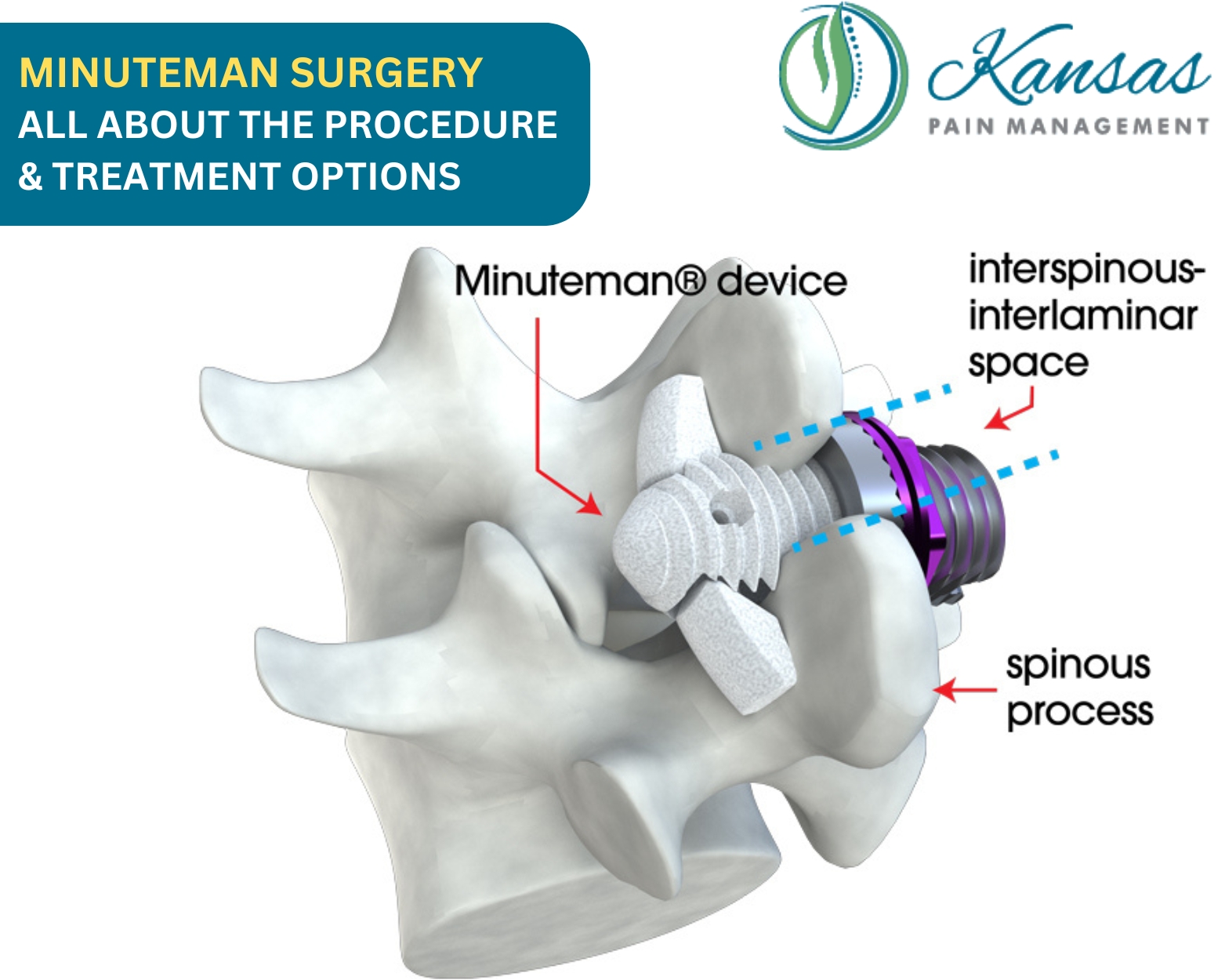 What is Minuteman surgery?