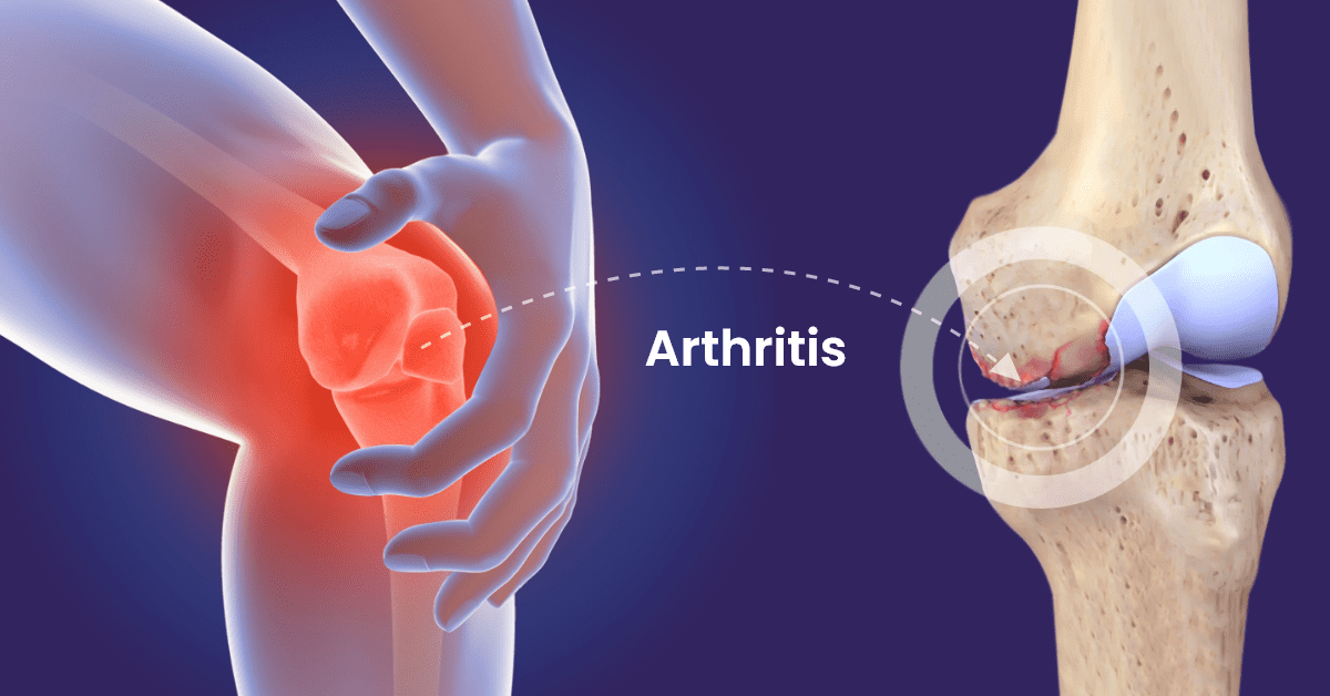 All You Need to Know About Arthritis