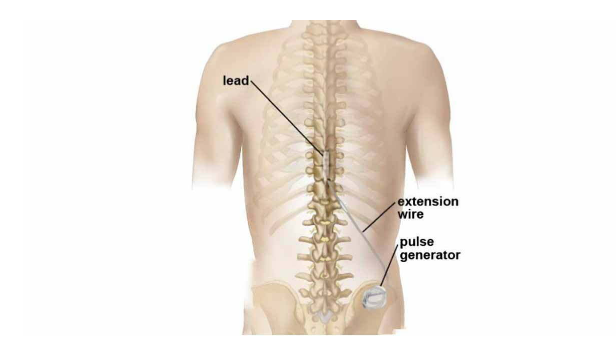 What is spinal cord stimulation?
