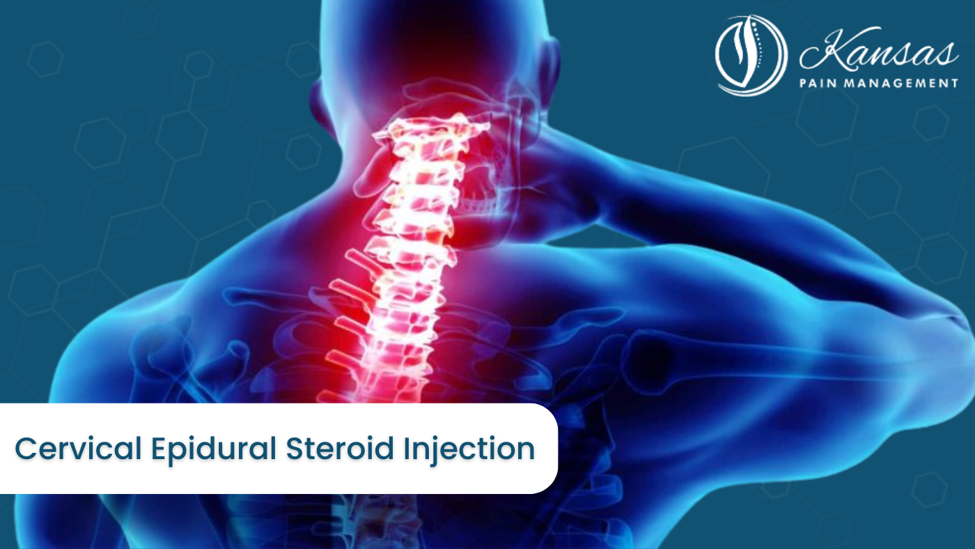 Cervical Epidural Steroid Injection