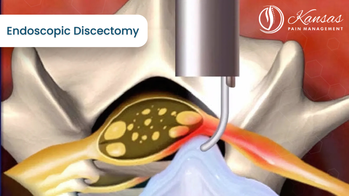 Endoscopic Discectomy