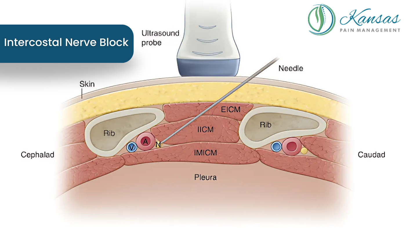 Intercostal Nerve Block