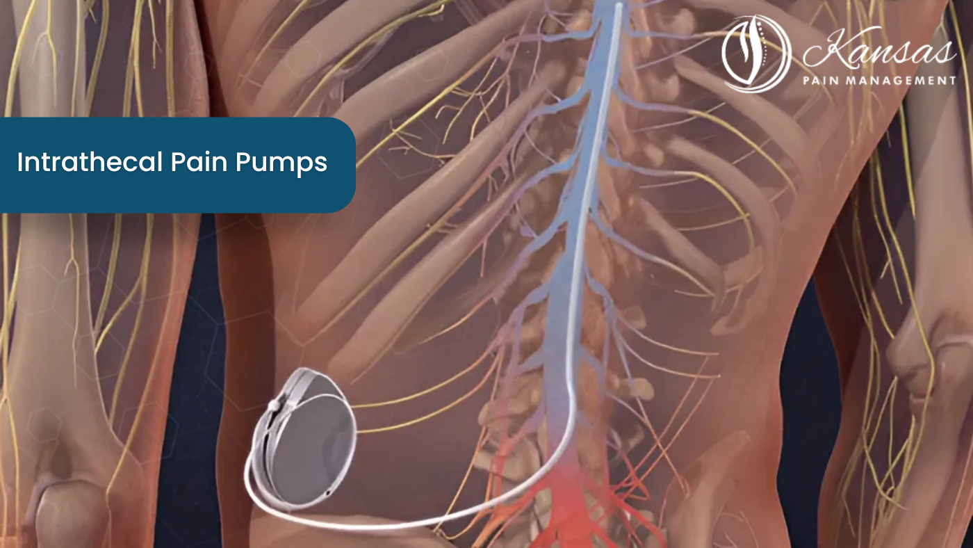 Intrathecal Pain Pumps
