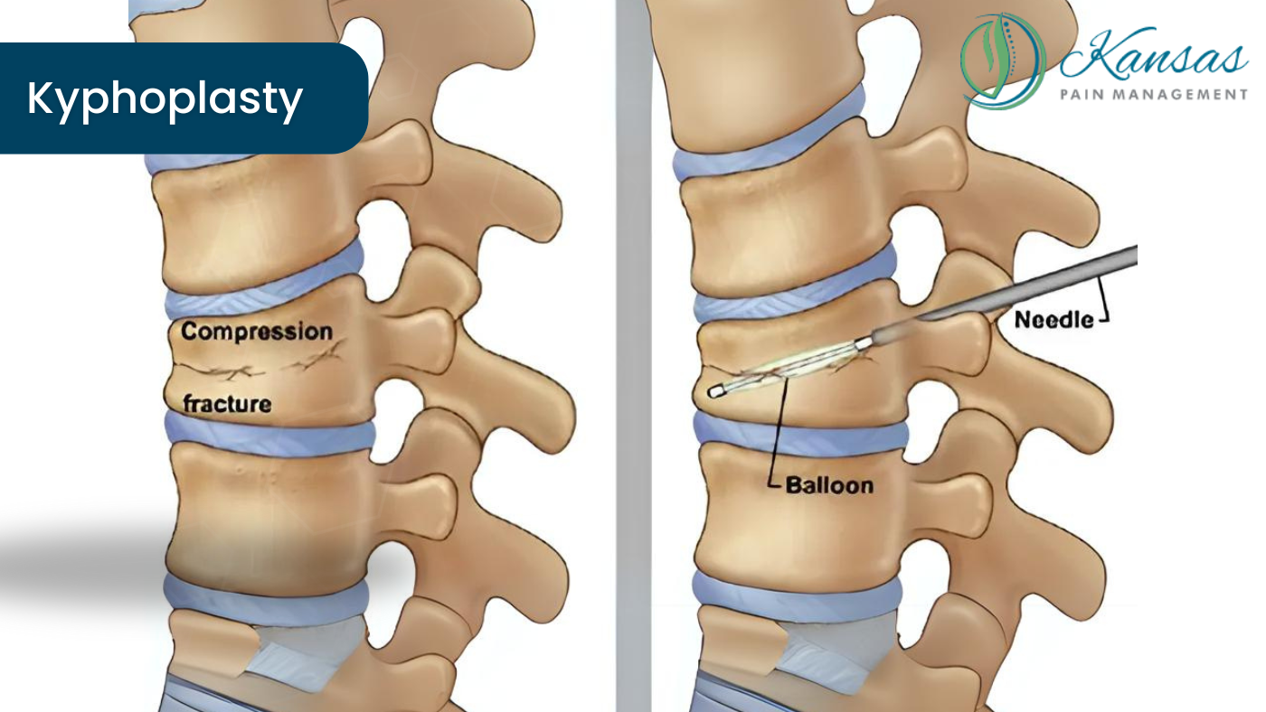 Kyphoplasty