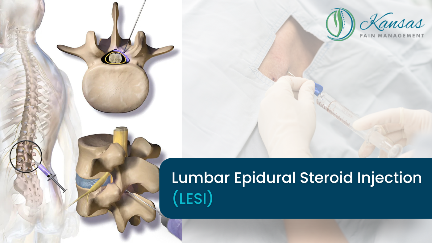 Lumbar Epidural Steroid Injection