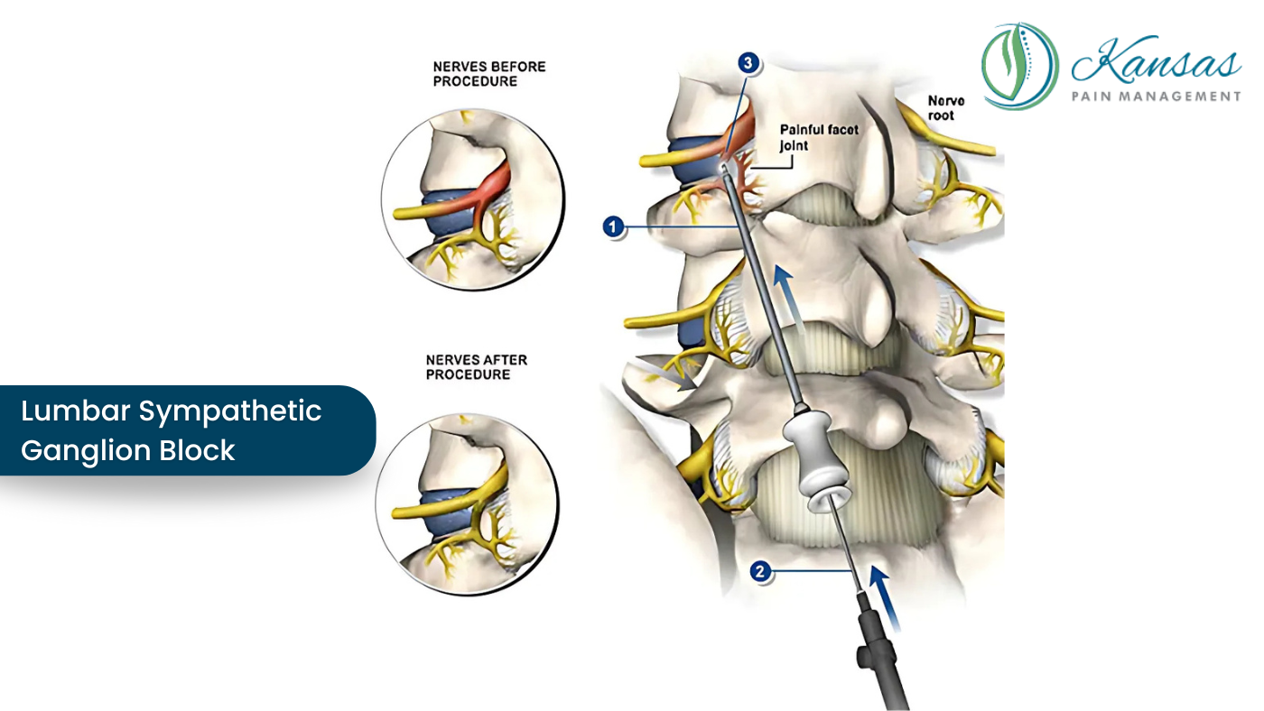 Lumbar Sympathetic Ganglion Block