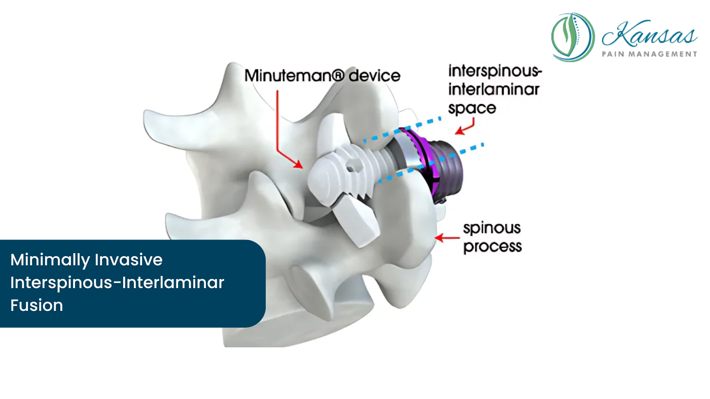 Minimally Invasive Interspinous-Interlaminar Fusion