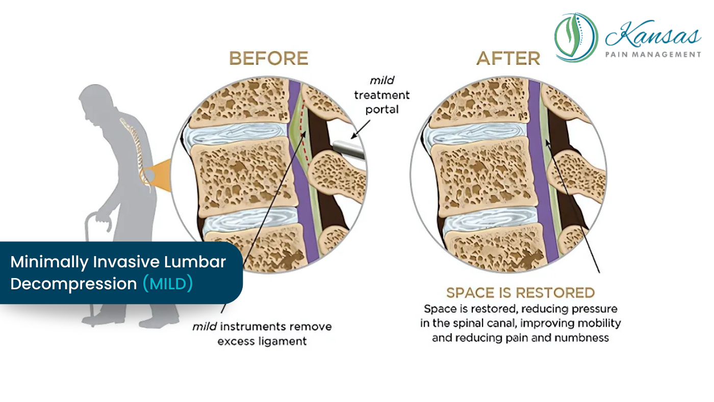 Minimally Invasive Lumbar Decompression