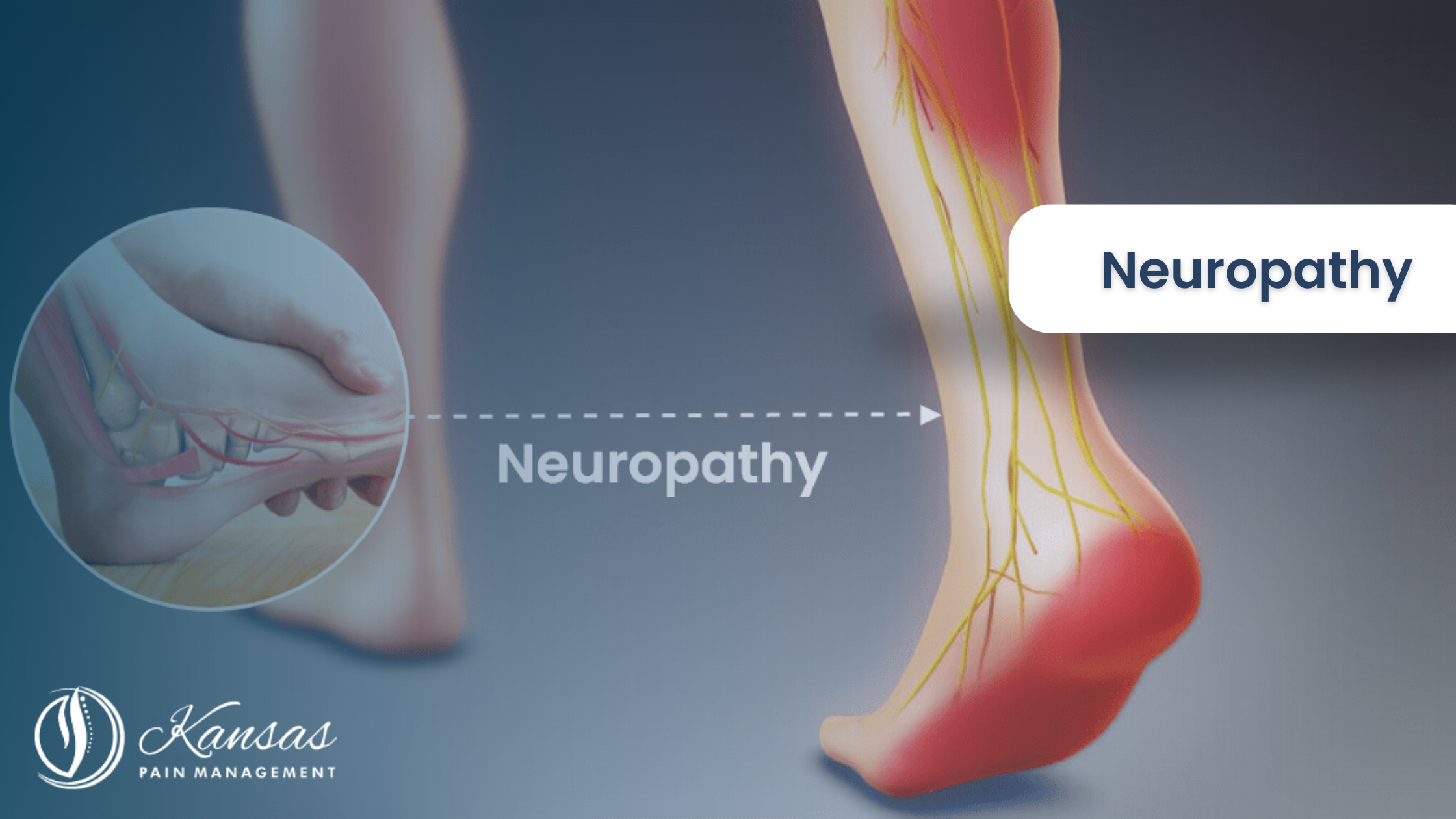 Neuropathy