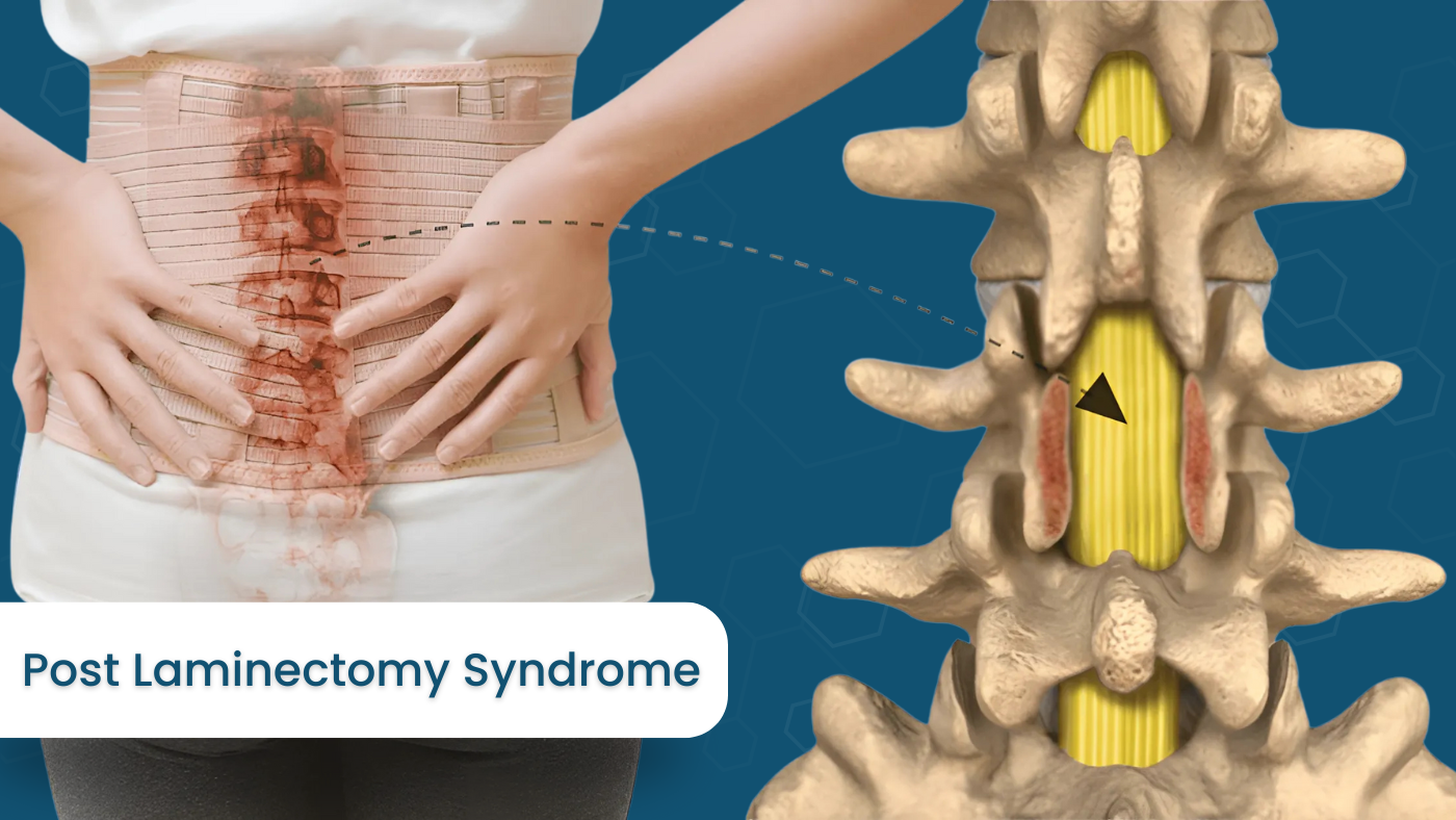 Post Laminectomy Syndrome