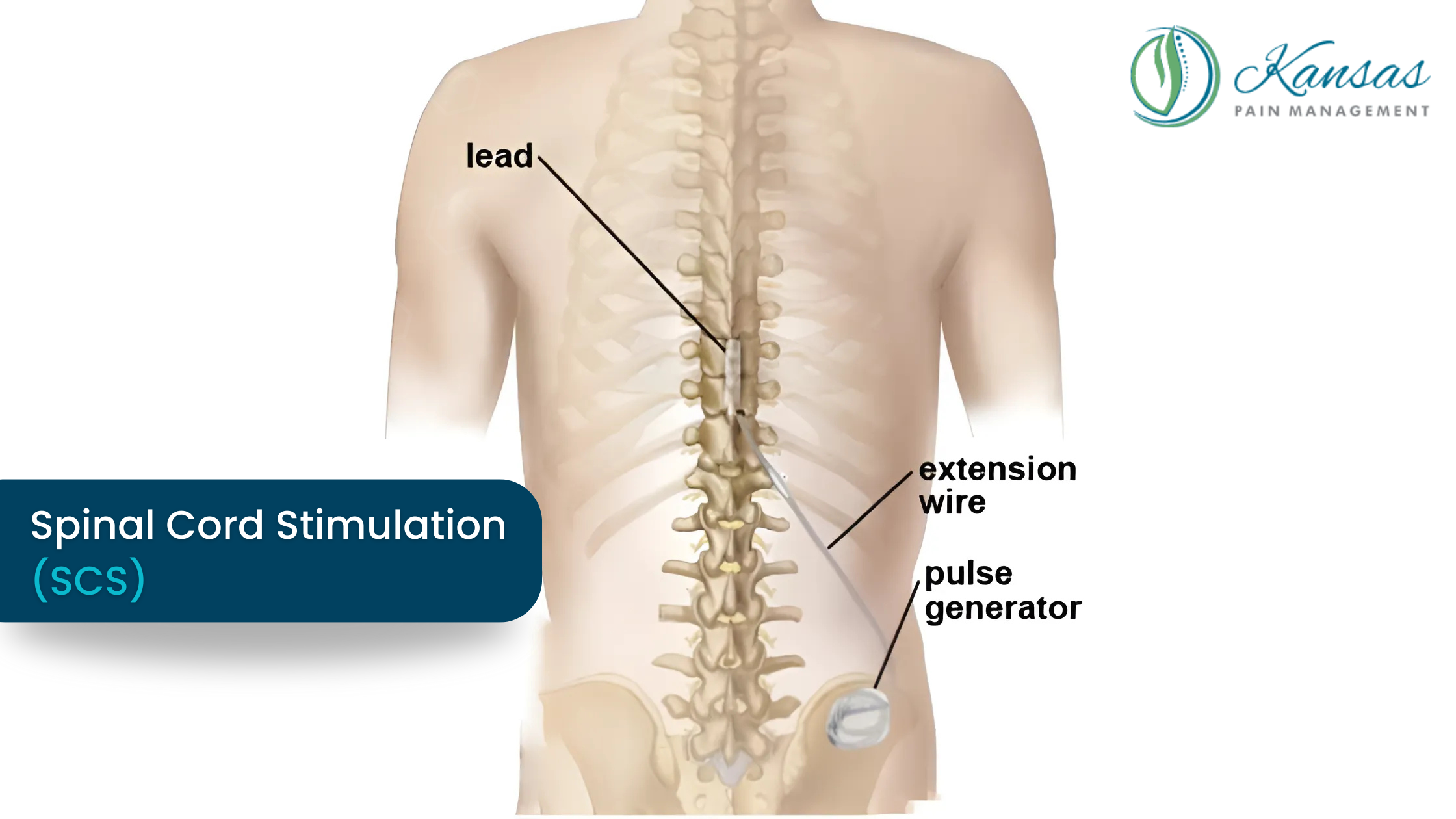 img Spinal Cord Stimulation (SCS)