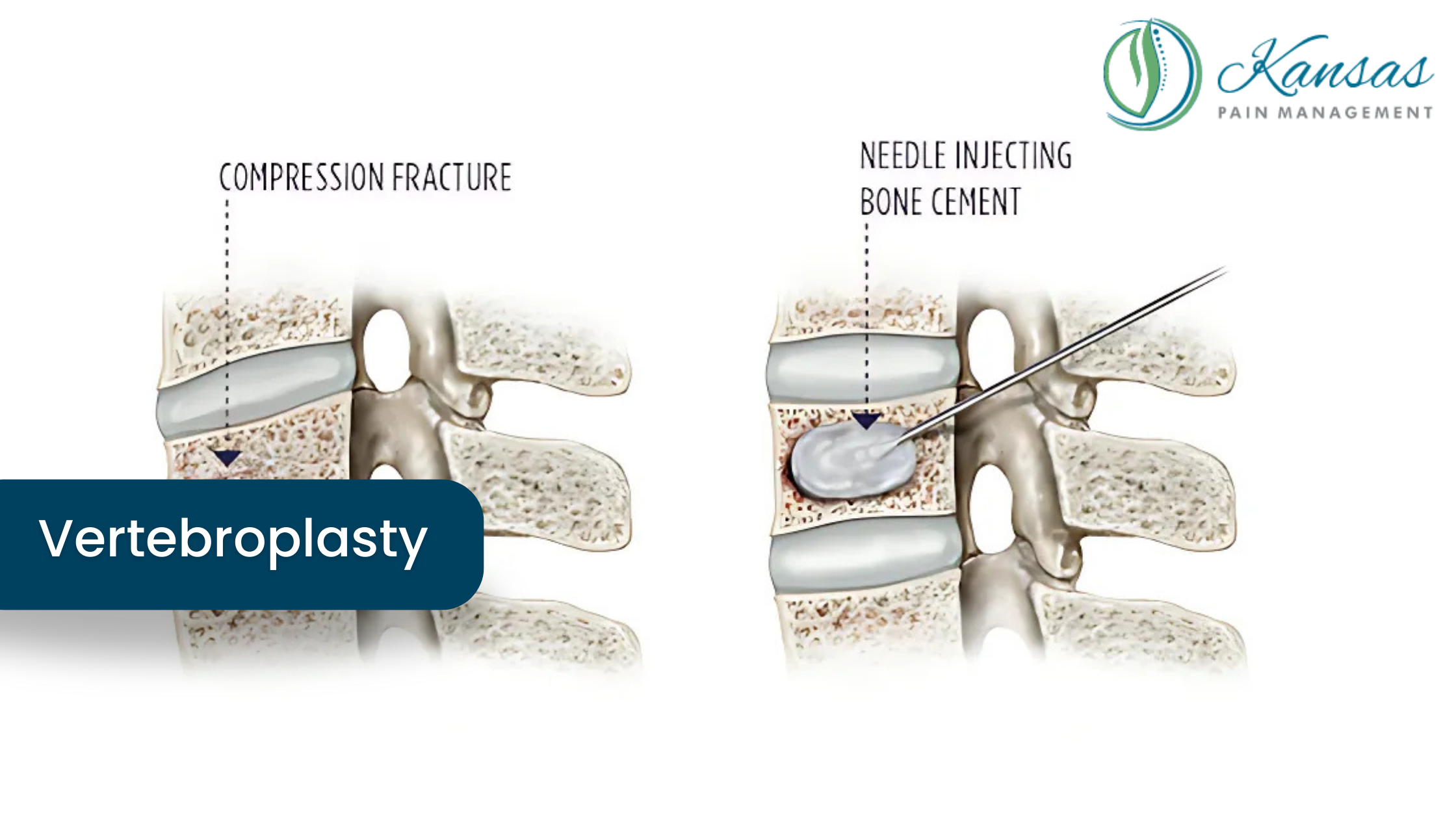 Vertebroplasty